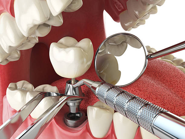 Best Emergency Root Canal Treatment in Briarcliff, TX